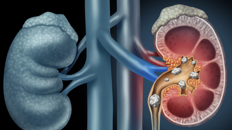 precio de la cirugia para tumores de riñón, próstata, vejiga, testículo en Merida