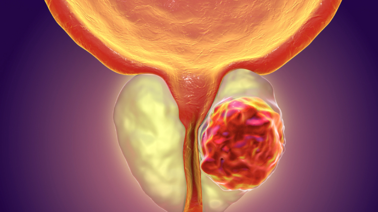 precio del tratamiento de cáncer de próstata en Merida