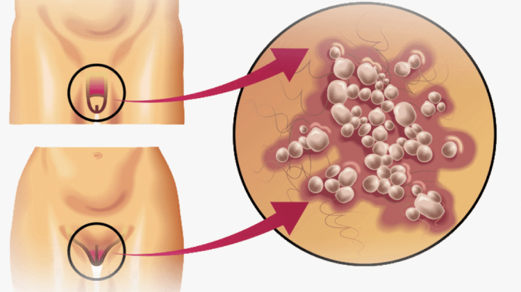 precio del tratamiento de eliminación de las Verrugas Genitales en Merida