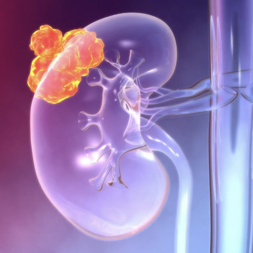 Tumores de Riñón, Próstata, Vejiga, Testículo en Merida