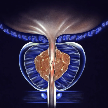 Costo del tratamiento de Cáncer de Próstata en Merida